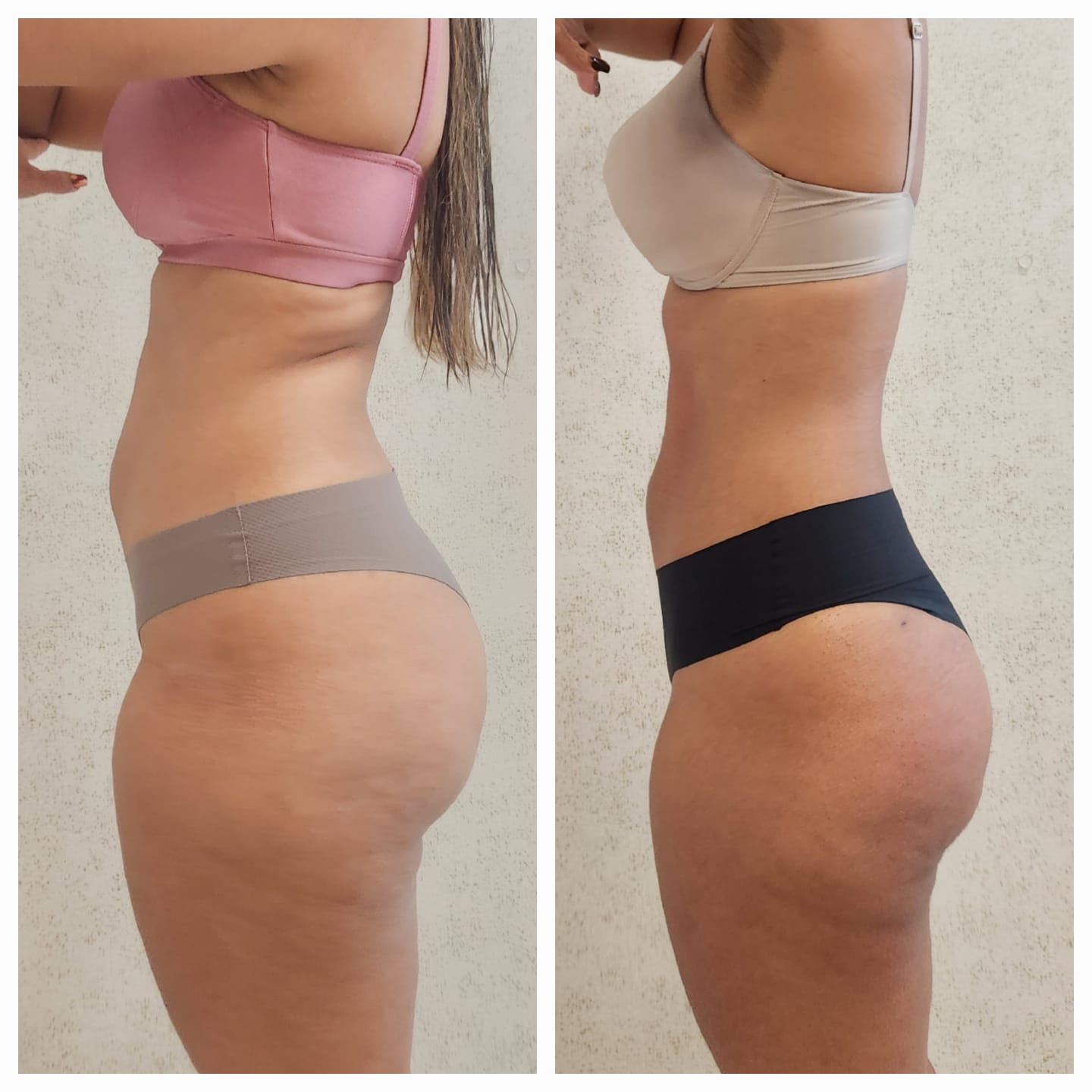 Resultado corporal em cintura e flancos