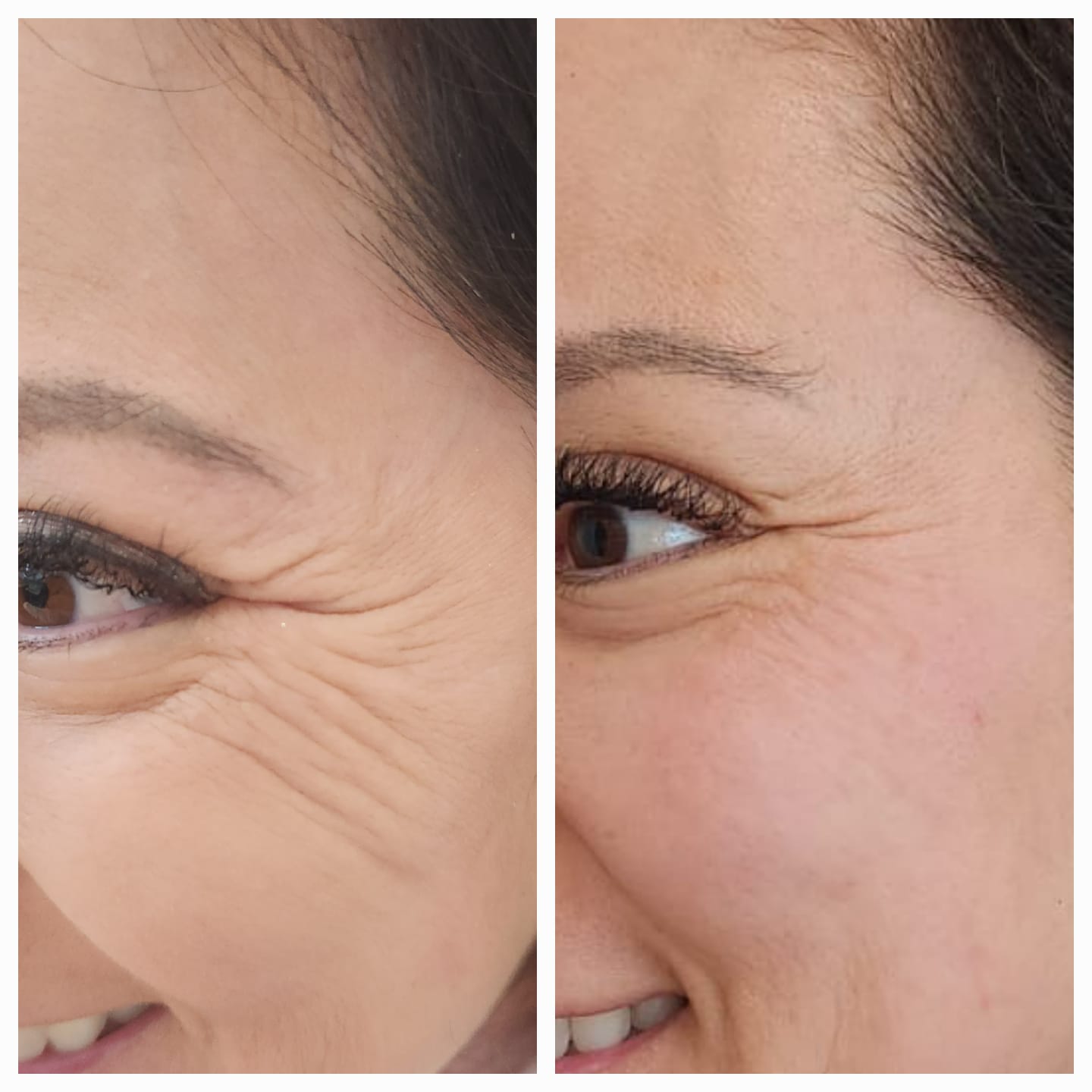 Resultado facial
