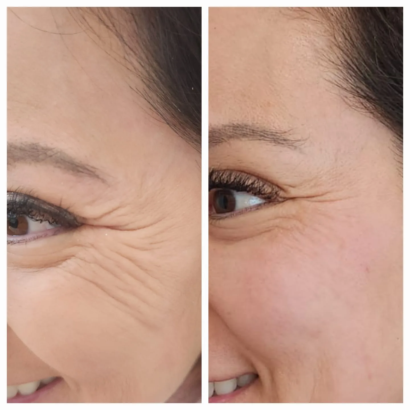 Botox deixa o rosto artificial? Mito e verdade