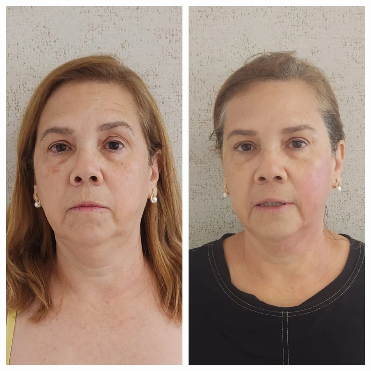 Comparação de atendimento facial — vista frontal
