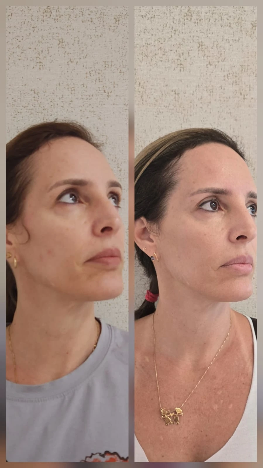 Comparação de atendimento facial — vista oblíqua