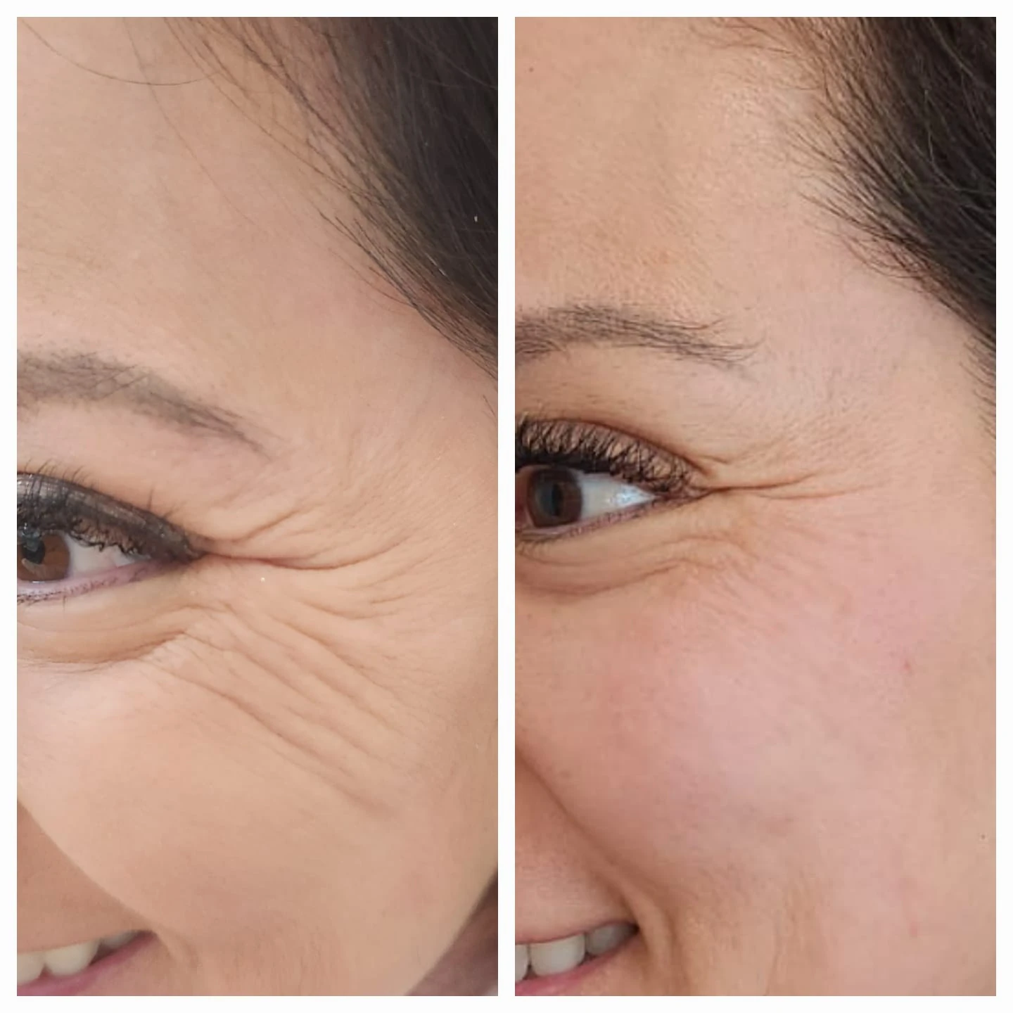 Comparação de atendimento facial — região lateral dos olhos