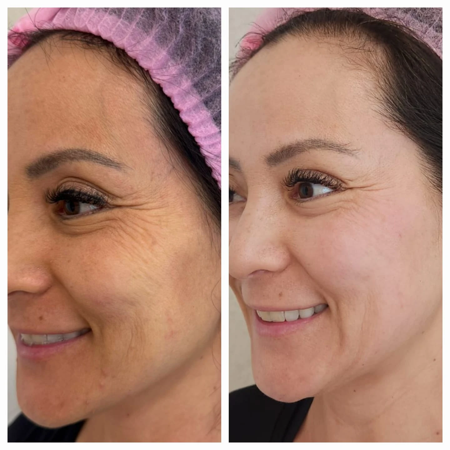 Comparação de atendimento facial — olhos e face lateral