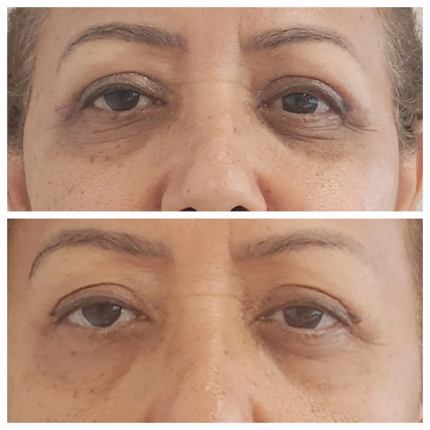Comparação de atendimento facial — olhos em vista frontal