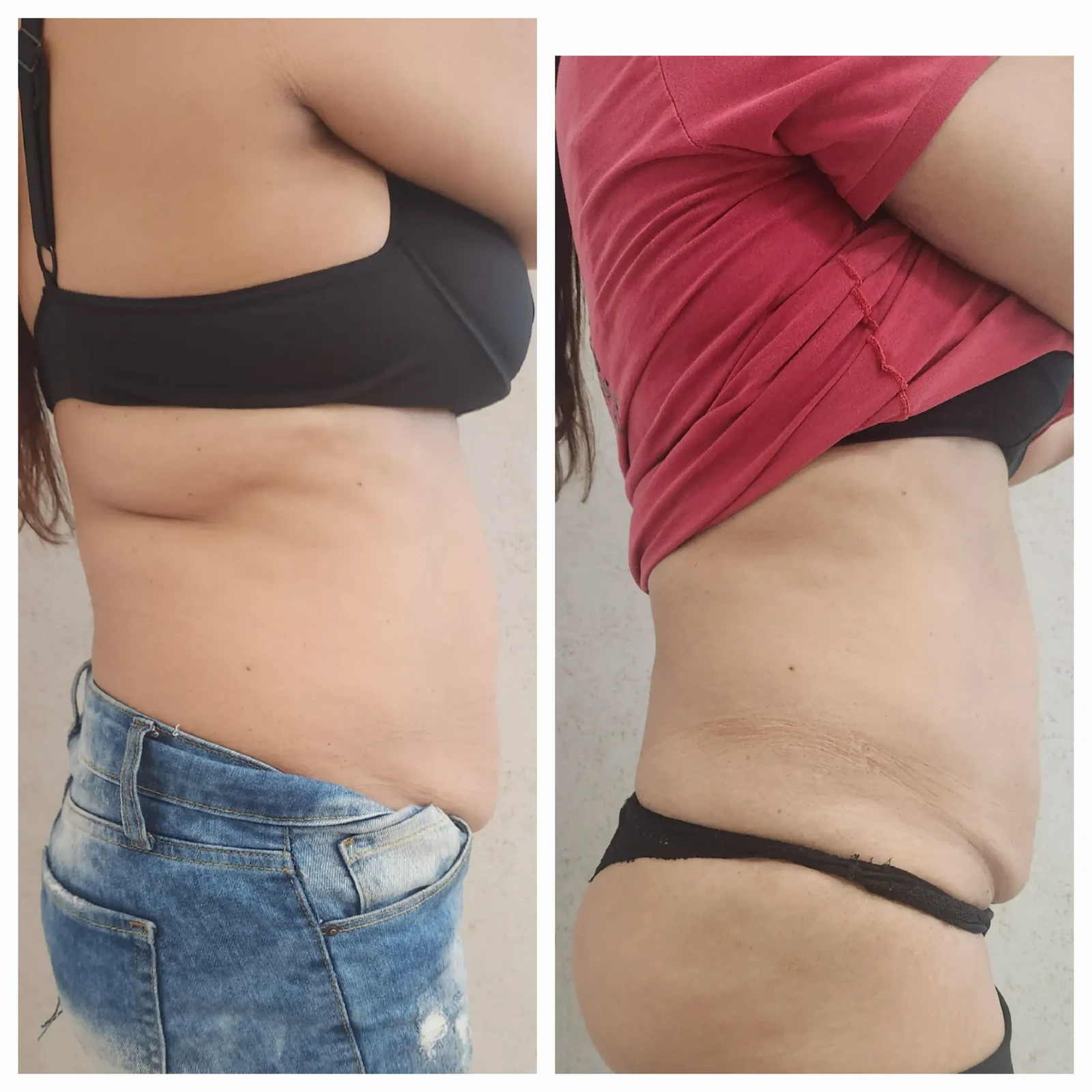 Antes e depois do Sculpt 360 — abdômen — vista lateral