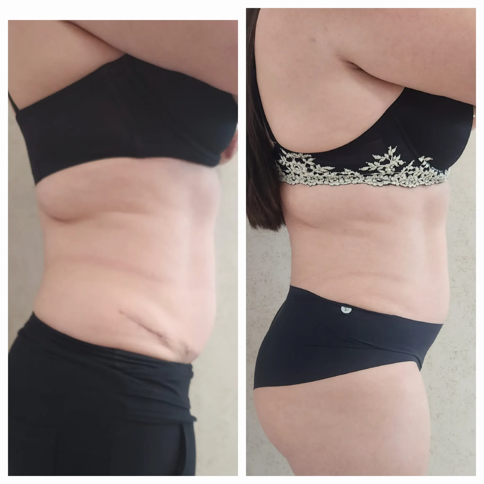Antes e depois do Sculpt 360 — abdômen e contorno lateral