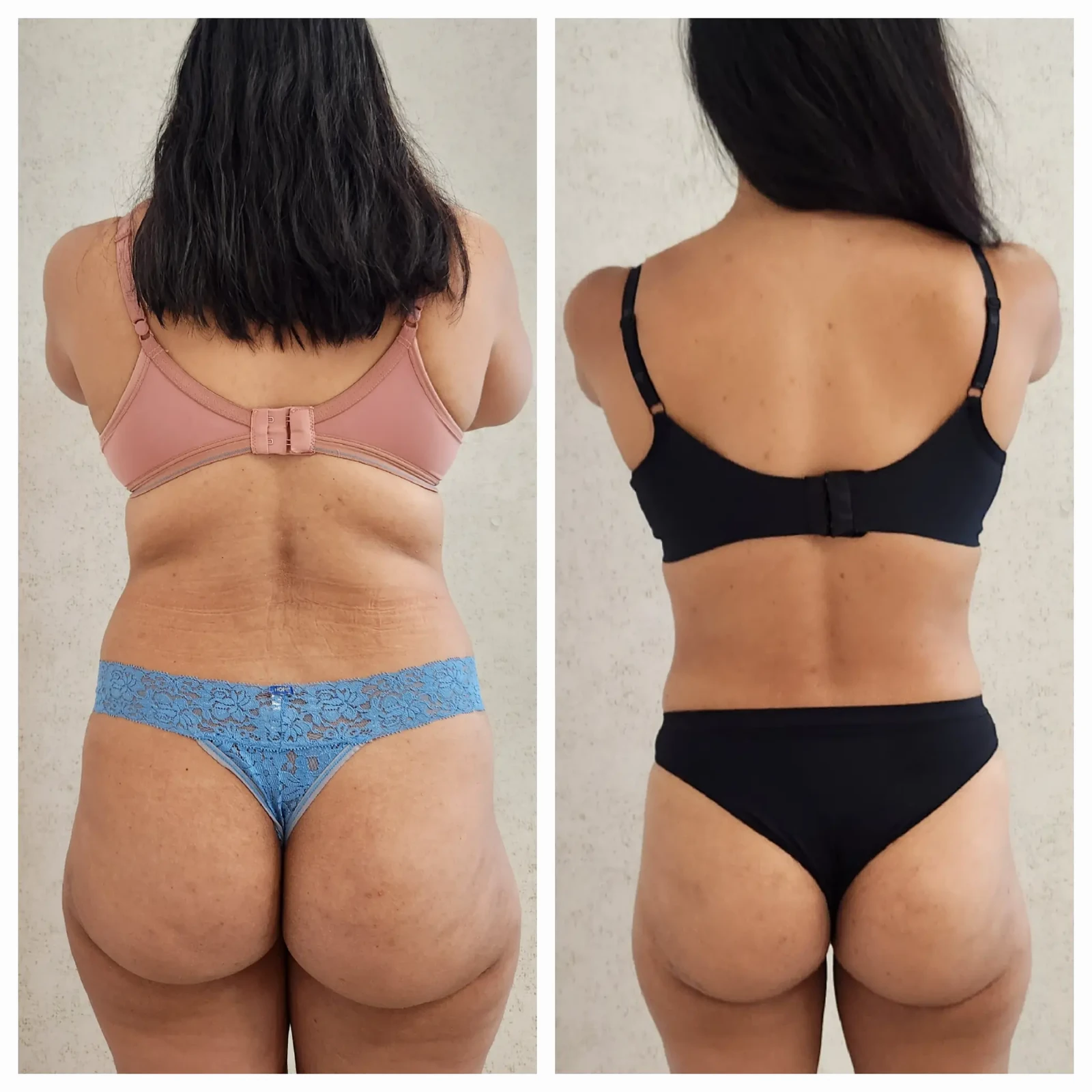 Antes e depois do Sculpt 360 — costas e contorno corporal