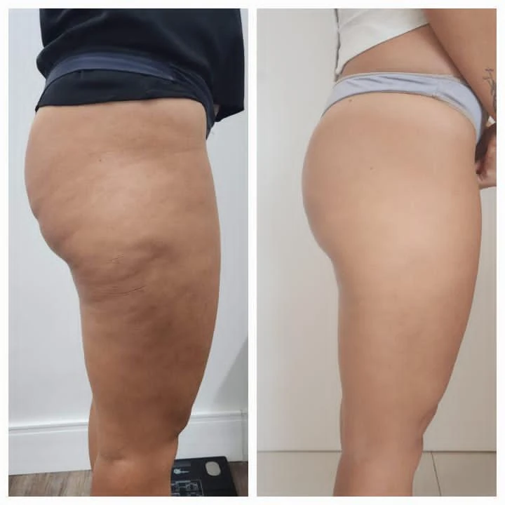 Antes e depois do Sculpt 360 — coxas — vista lateral