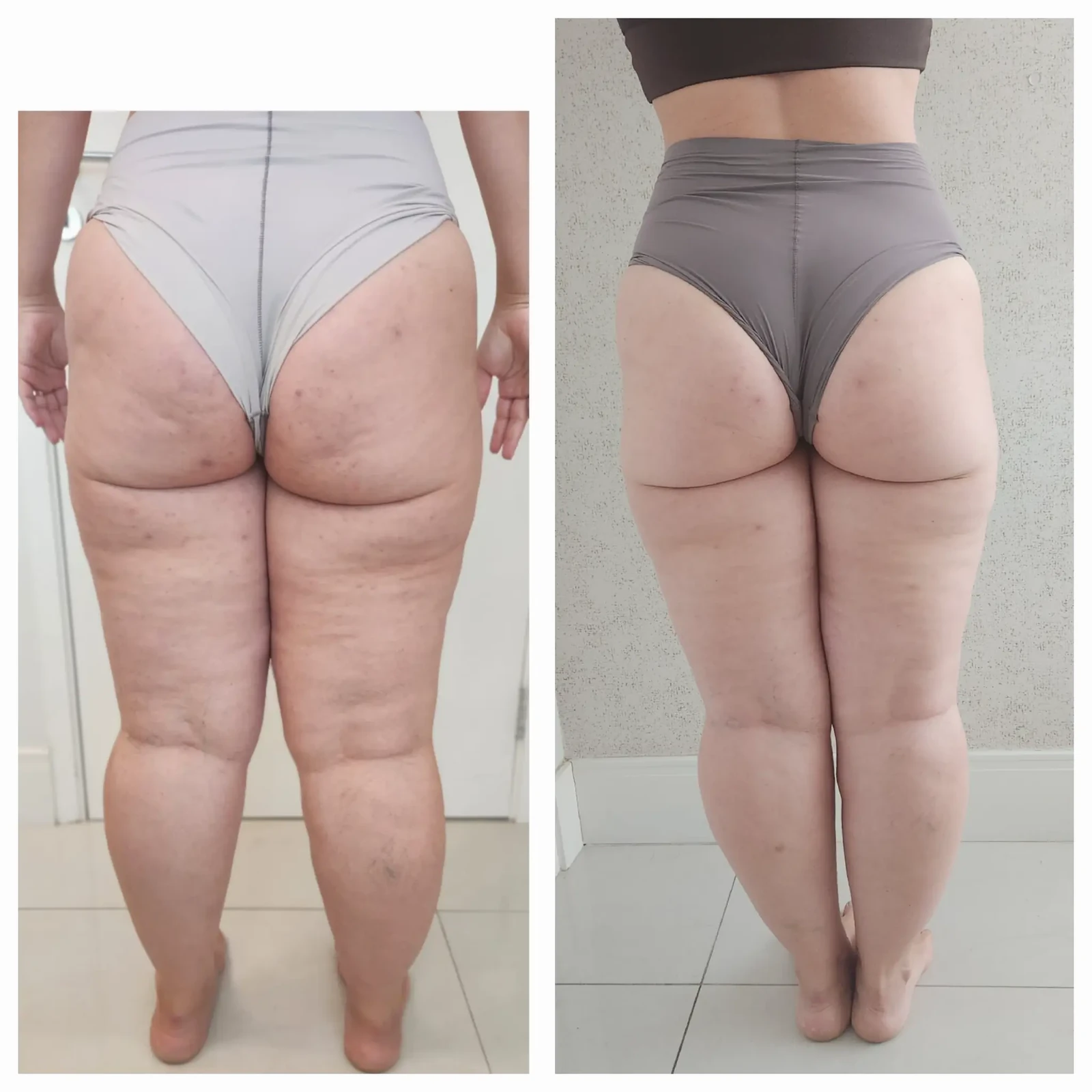 Antes e depois do Sculpt 360 — coxas — vista posterior